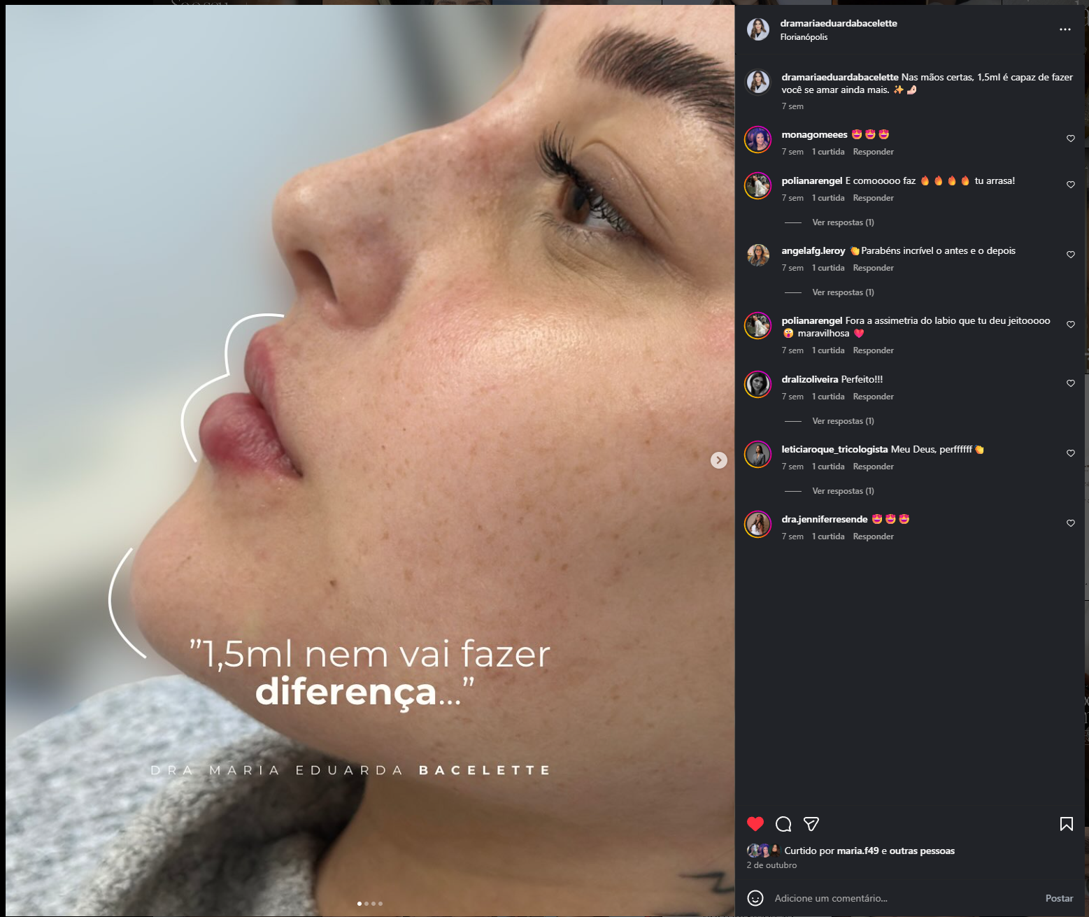 Preenchimento labial com naturalidade