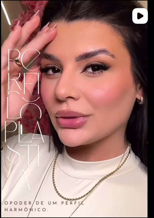 Reel de perfiloplastia com harmonização facial
