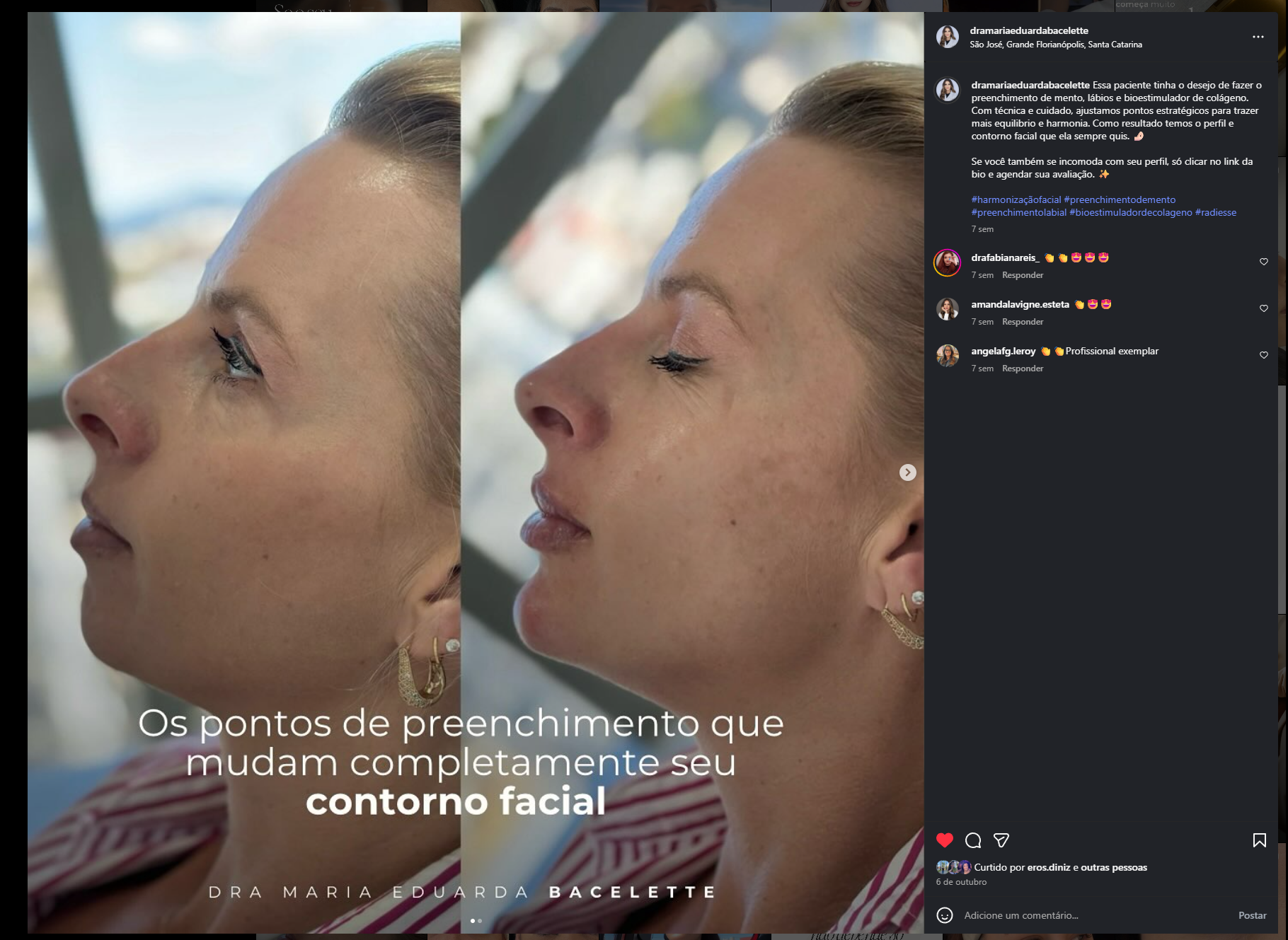 Antes e depois de preenchimento de mento e contorno facial