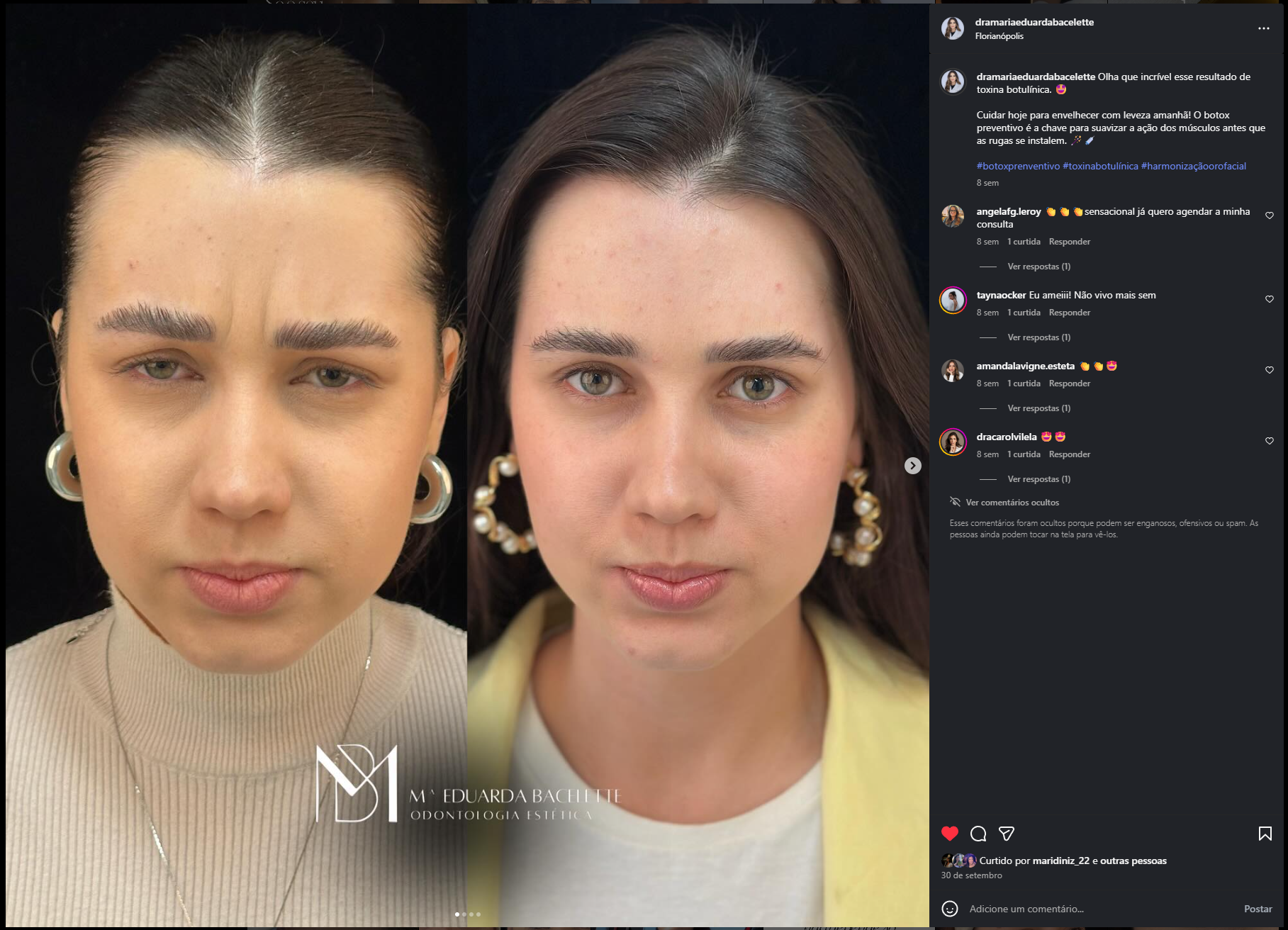 Resultado de rejuvenescimento facial com naturalidade